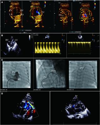 A case report of pulmonary atresia with intact ventricular septum: an extraordinary finding of subsystemic right ventricle